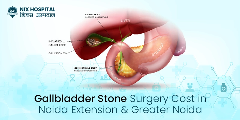 Gall Bladder Stone Surgery Cost in Noida Extension and Greater Noida Service